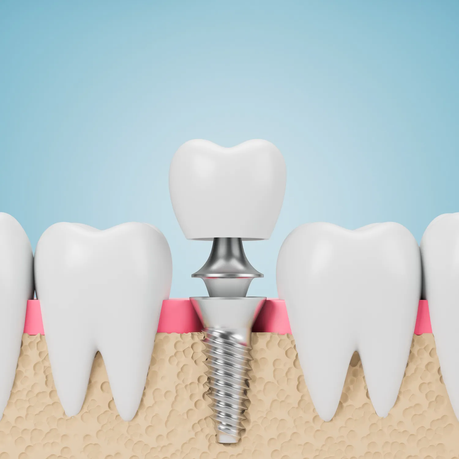 Dentysta Warszawa implanty